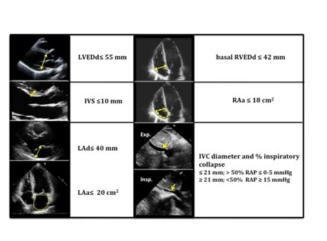 normal lv end diastolic diameter